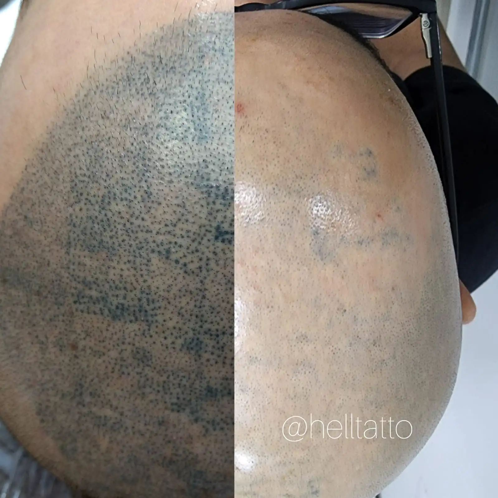 remoção de micropigmentação capilar