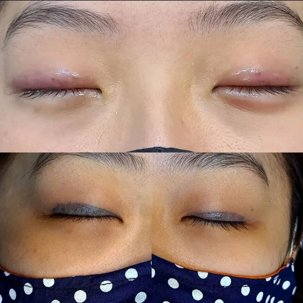 seguranca-ocular-durante-a-remocao-de-tatuagem-na-face