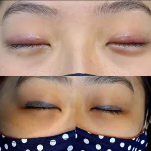 seguranca-ocular-durante-a-remocao-de-tatuagem-na-face