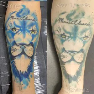 Arrependeu de uma tatuagem