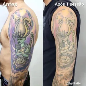 Recuperação remoção de tatuagem