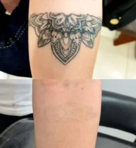 Interessado em trabalhar com remoção de tatuagem?