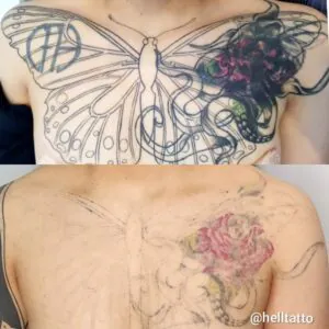 remoção de tatuagem multicoloridas