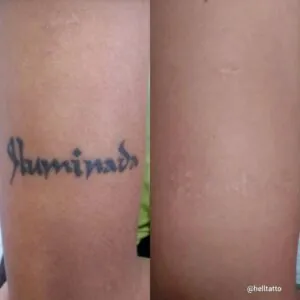 Remoção de Tatuagem Hipopigmentação