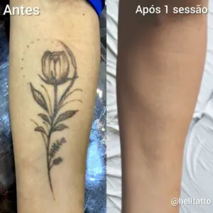 Remover tattoo em uma sessão