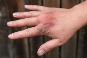 Remoção tatuagem em casa