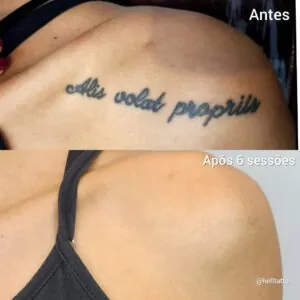 remoção-de-tatuagens-antigas