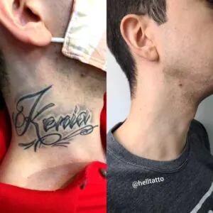 Desistir remoção de tatuagem