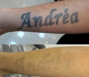 remocao-de-tatuagem-de-ex