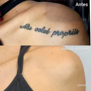 Remoção de tatuagem de frases