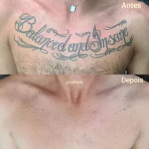 Remoção de tatuagem Hell Tattoo