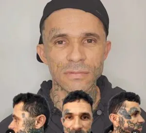 remoção de tatuagem Byller