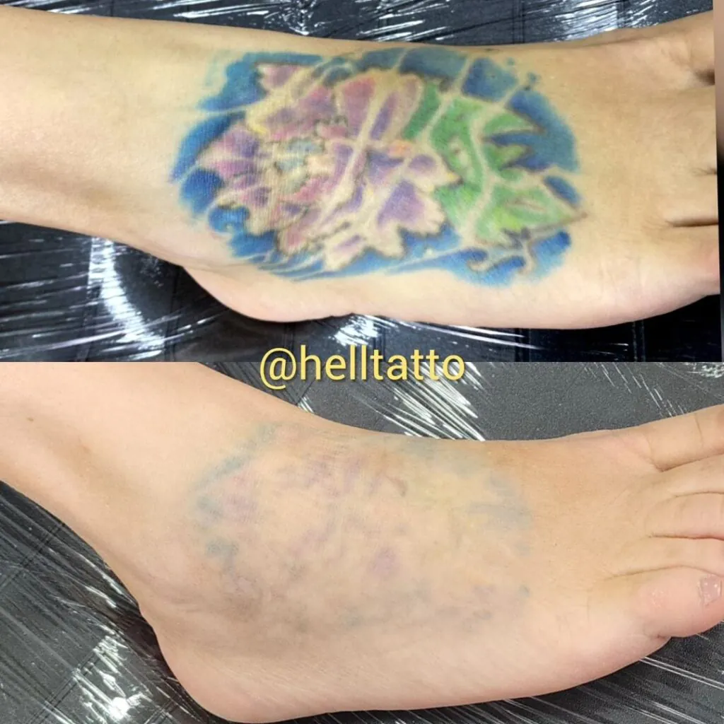 Remover tatuagem recente ou antiga