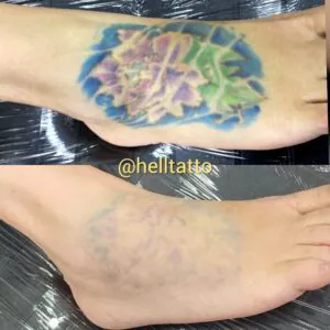 Remover tatuagem recente ou antiga
