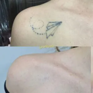 Remover tatuagem recente ou antiga
