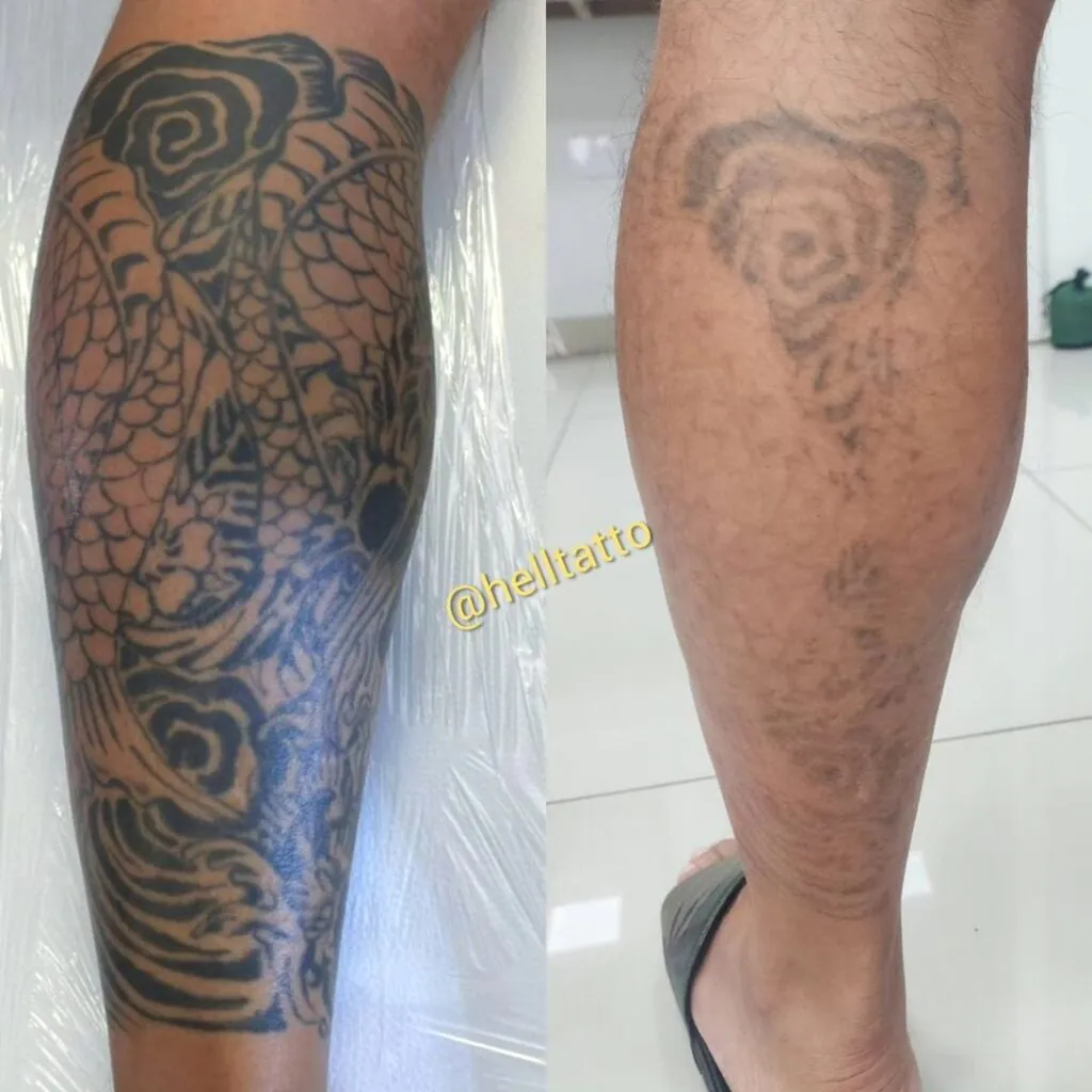 Remoção de tatuagem