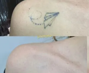 remover-tatuagem-dor