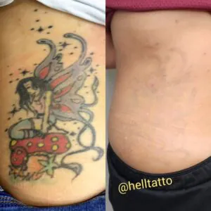 Remoção de tatugem tempo cicatriz