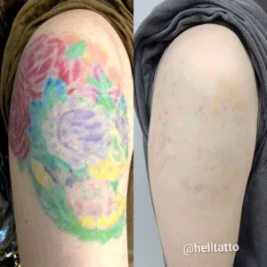 Remover tatuagem mancha