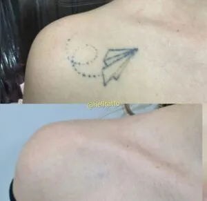 e-melhor-remover-tatuagem-nova-ou-velha