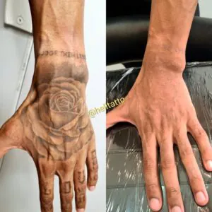 e-possivel-remover-uma-tatuagem-completamente-veja-3-fatores-que-influenciam-no-resultado-02
