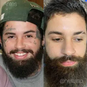 passo-a-passo-do-processo-de-remocao-de-tatuagem-02