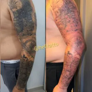 pele-na-primeira-sessao-de-remocao-de-tatuagem