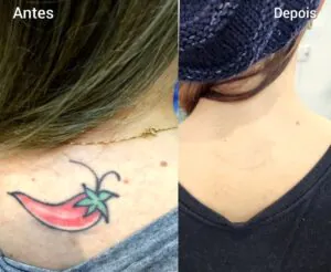quais-os-cuidados-apos-a-remocao-de-tatuagem-a-laser