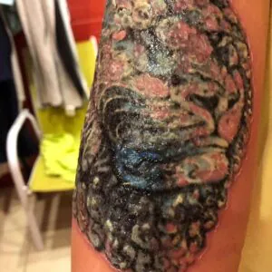 quais-sao-os-riscos-de-remover-uma-tatuagem-01