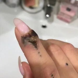 quais-sao-os-riscos-de-remover-uma-tatuagem-02