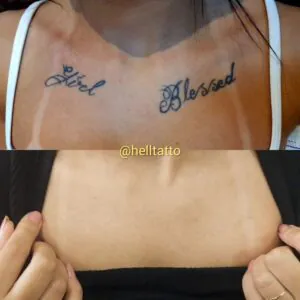 quais-tatuagens-sao-mais-faceis-de-remover