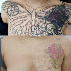 quanto-custa-para-remover-uma-tatuagem-de-30-cm