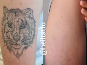 quanto-custa-remover-uma-tatuagem-em-2024