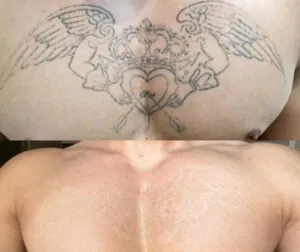 quem-nao-pode-fazer-remocao-a-laser