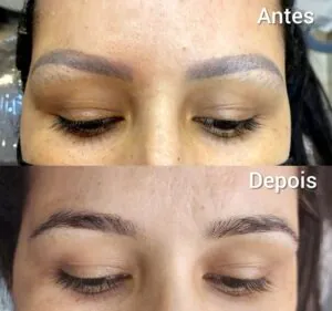 remocao-de-micropigmentacao-de-sobrancelha-funciona
