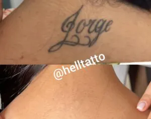 sessoes-necessarias-para-apagar-tatuagem-preta-02