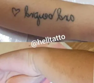 sessoes-necessarias-para-apagar-tatuagem-preta