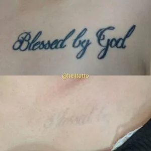 tempo sessão remoção de tatuagem