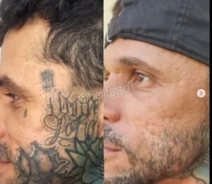 existe-a-possibilidade-de-uma-tatuagem-removida-voltar