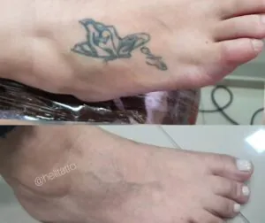 o-papel-da-idade-da-tatuagem-no-processo-de-remocao