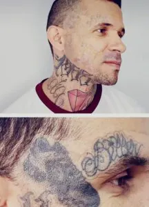 remoção de tatuagem byller