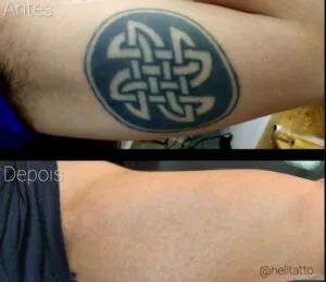 remocao-de-tatuagem-como-minimizar-o-desconforto-durante-as-sessoes