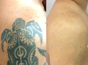 vantagens-do-laser-em-comparacao-a-outros-metodos-de-remocao