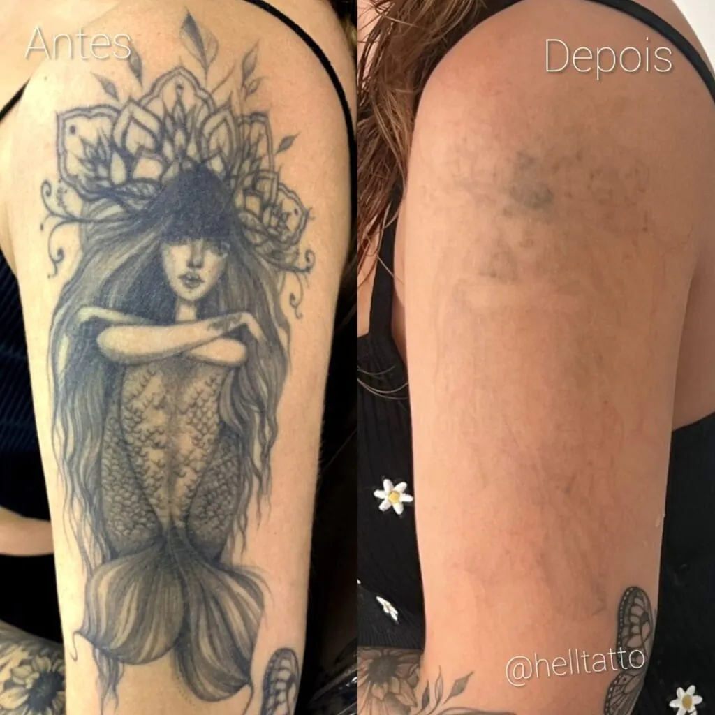 Como acelerar remoção de tatuagem 1