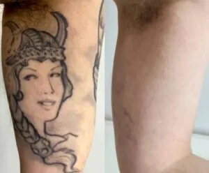 7-perguntas-frequentes-sobre-remocao-de-tatuagem