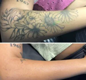 7-perguntas-frequentes-sobre-remocao-de-tatuagem-02