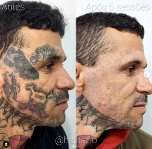 calcule-gratuitamente-aqui-a-quantidade-de-sessoes-para-remover-sua-tatuagem-02