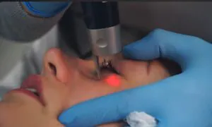 conheca-o-metodo-de-remocao-de-micropigmentacao-de-olheiras