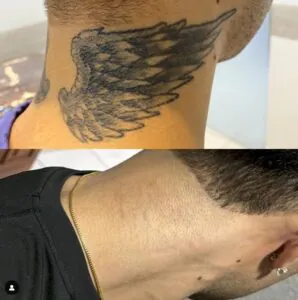remoção-de-tatuagem-casa-branca