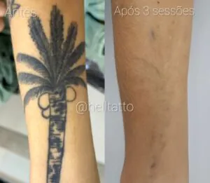 remocao-de-tatuagem-em-diferentes-tipos-de-pele